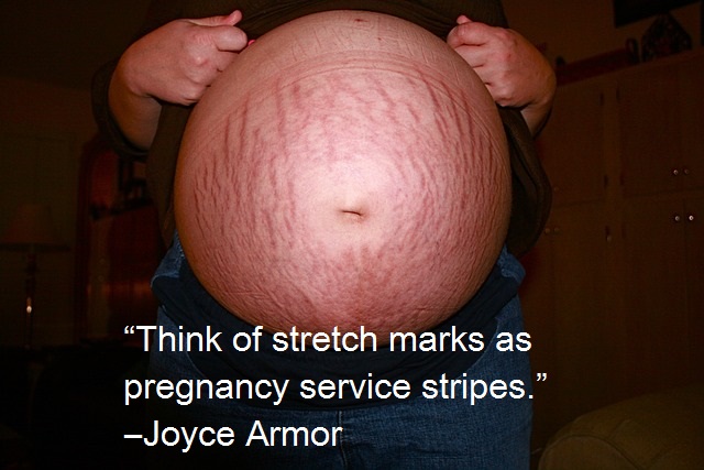 Causes And Cure For Pregnancy Stretch Marks Science And Samosa